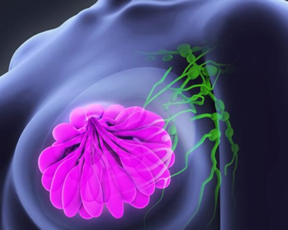 breast_cancer
